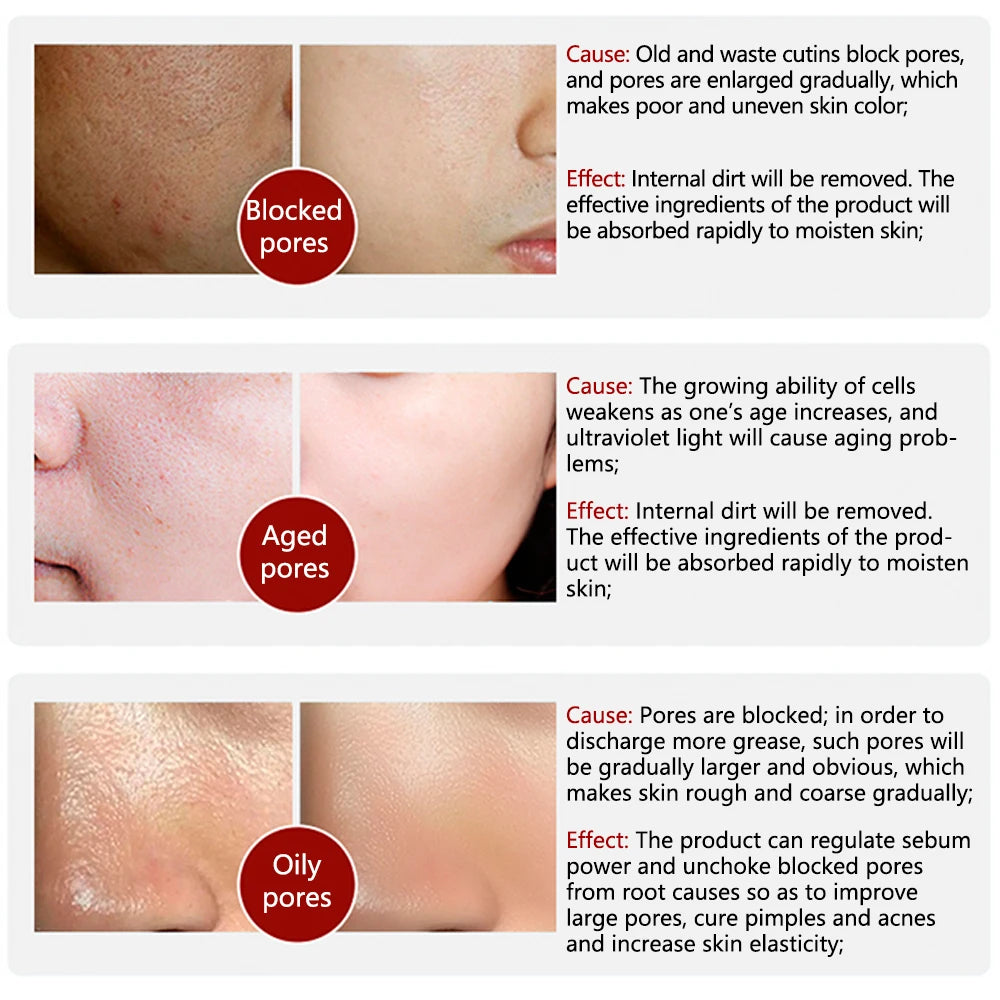 LANBENA Pore reatment Essence Shrink Pores Acne Treatment Remover Nose Blackhead Skin Firming Moisturizing Face Serum Skin Care